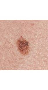 signs of skin cancer this skin check can save your life