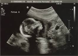 Level 2 Ultrasound: Price, Purpose, Procedure & Report