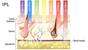 In general, ipl shouldn't hurt and if it does, cease treatment and try a lower setting. Ipl Vs Laser Hair Removal Treatment Hair Removal Prettylasers