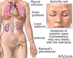 The inflammation seen in lupus can affect various organs and tissues in your. Systemic Lupus Erythematosus Medlineplus Medical Encyclopedia