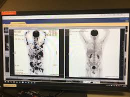 Composite complete remission (crc) is the sum of complete remission (cr), i.e. They Call Me Complete Remission