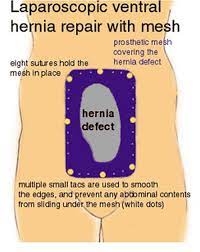 Ventral Hernia Definition Symptoms Causes Repair Surgery Hernia Repair Umbilical Hernia Repair Umbilical Hernia