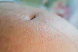 Image result for pruritic urticarial papules and plaques of pregnancy