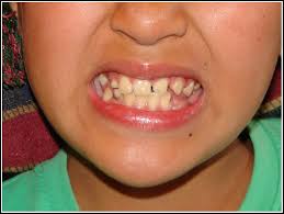 What are the symptoms of a rotten tooth? Rotten Teeth Too Much Sugar Too Many Sweets And This Is Flickr