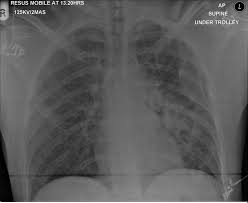 Image result for Pulmonary Contusion