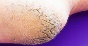 Voici Comment Soigner Les Pieds Secs Fendilles Et Pleins De Callosites A La Maison Pied Sec Pedicurie Soin Des Pieds
