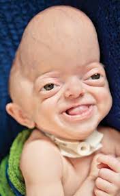 thankful for crouzon syndrome