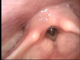 Image result for Relapsing Polychondritis