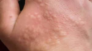 Typically, your symptoms of hives should disappear within 24 hours from the first hour it manifested on your skin. Stinging Nettle Rash Pictures Treatment Home Remedy