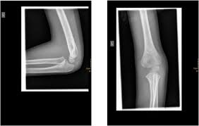 If this muscle is elevated to expose a fracture line, care must be taken to protect the ulnar nerve deep to it. Journal Of Medical And Psychological Trauma Open Access Pub