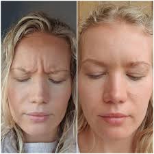 Botox ® cosmetic may cause serious side effects that can be life threatening. Bruxism Archives Charlotta Eve