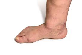 Image result for diabetic toes