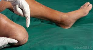 Jan 23, 2018 · a dislocated kneecap is yet another common knee condition. What Are The Symptoms Of Knee Dislocation With Pictures