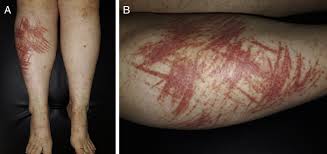 Image result for koebner phenomenon psoriasis