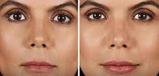 What are the potential side effects of juvéderm ® voluma ™ xc? How Long Do Fillers Last And Who S A Good Candidate Cherokee Women S Health