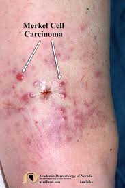 Image result for Merkel Cell Carcinoma