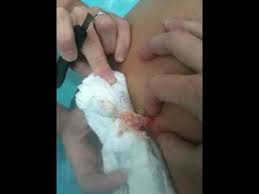 They're about the size of a pea. Poolside Surgery Youtube