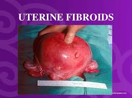 These fibroids are made up of groups of muscle cells and other tissues, and can range in size from as small as a pea to as large as 5 to 6 inches (12.7 to 15.24 centimeters) wide. Uterine Fibroids