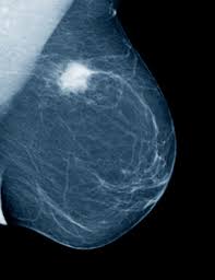 A breast mri captures multiple images of your breast. What Is A Mammogram How Does It Detect Breast Cancer