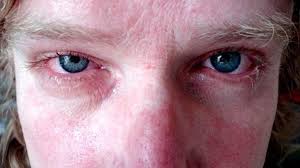 Rhume Des Foins Le Remede Naturel Efficace Que Personne Ne Connait Oeil Qui Pleure Remedes Naturels Nez Qui Coule