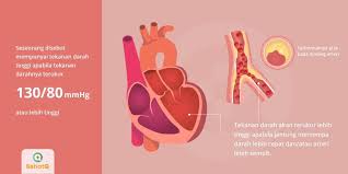 Diterbitkan july 25, 2017 dalam kategori. Hipertensi Tanda Dan Gejala Penyebab Cara Mengobati Cara Mencegah
