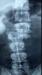 Image result for Spinal Trauma