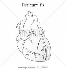 The heart muscle is weakened, however, by an inflammation of the heart. Pericarditis Vector Photo Free Trial Bigstock