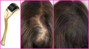 Stem cells also get activated. How To Regrow Hair With A Derma Roller Derma Rolling Scalp For Faster Hair Growth Grow Thin Hair Youtube