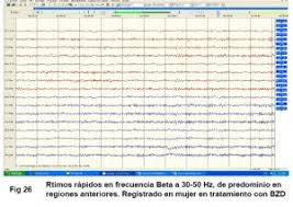 Muerte cerebral o muerte encefálica. Electroencefalografia En Cuidados Criticos