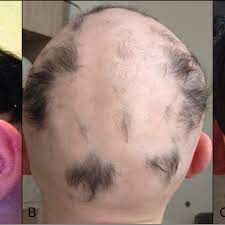 Any sign of sudden hair loss should be evaluated by a physician familiar with hair loss and hair restoration. Hair Regrowth On A 20 Year Old Patient S Scalp After Fmt A The Download Scientific Diagram