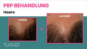 prp haare eigenbluttherapie bei haarausfall dr turkof 1060 wien youtube