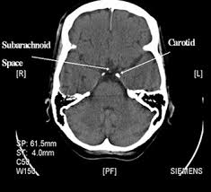 There is hypoattenuating (dark) peritumoral edema in the contrast agent uptake, sometimes in characteristic patterns, can be demonstrated on either ct or mri scans in most malignant primary and metastatic brain tumors. Can Anyone Provide Brain Tumor Ct Images For My Research Work