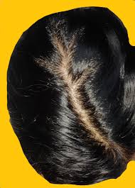 We have seen that many women do best with levels above 50, and closer to 100… especially if you struggle with low thyroid and/or hair loss. Need Advice F23 Low Ferritin Seb Dermatitis Hair Loss Femalehairloss