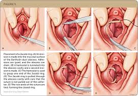 Image result for Bartholin's gland abscess