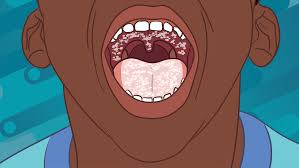 Image result for Candidiasis