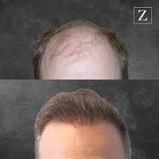 Book appointments on facebook with hair replacement service in los angeles, california. Male Hair Transplant Before And After Photos Ziering Medical