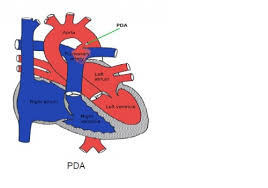 Patent ductus arteriosus (pda) is a medical condition in which the ductus arteriosus fails to close after birth: Conditions Leeds Congenital Hearts