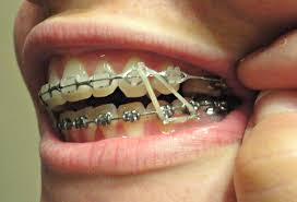 When You Get Braces What Do The Different Kinds Of Rubber Bands You Put In Your Mouth Mean Nostupidquestions