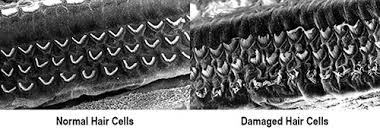 We have about 15,000 of them in each ear, and they're crucial to helping us detect sound waves. How Does Loud Noise Cause Hearing Loss Nceh Cdc