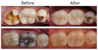 The final cost of your crown depends on a number of variable factors. Dental Crowns And Bridges North Sydney Dentistry North Sydney Dental North Sydney Dentist