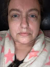 Hailey Bieber showed off her toned abs in a chic crop top just days after  revealing a perioral dermatitis flare-up.