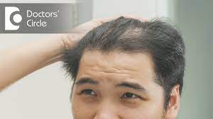 This works especially well in patients with inflammatory scalp disease, dr. How To Treat Hair Thinning In Front Part Of The Scalp Dr Nischal K Youtube