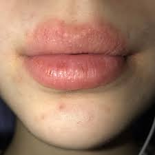 Was Tun Bei Entzundeten Lippen Gesundheit Und Medizin Entzundung Lippe