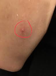 Early detection of mrsa colonization and eradication are necessary for rehabilitation. Sieht Das Nach Dem Krankenhauskeim Mrsa Aus Gesundheit Und Medizin Medizin Angst