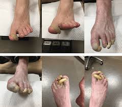 See more ideas about toenail fungus, foot fungus, athletes foot. Toenail Fungus Specialist Hagerstown Md Frederick Md Daniel D Michaels Dpm Ms Dabfas Podiatrist Reconstructive Foot Ankle Institute Llc