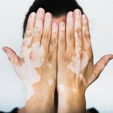 Lenfoma tanımı, belirti ve bulguları, nedenleri, teşhis ve tedavisi. Vitiligo Medicana Saglik Grubu