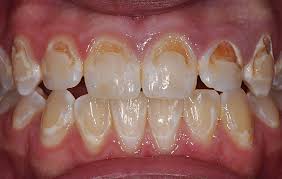 It turns the tooth its natural shape and allows usual functioning. Dental Photos Before After Photos Evanston Dentist