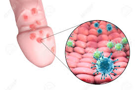 Genital Herpes Lesions And Close Up View Of Herpes Simplex Viruses Attaching To Human Cells 3d Illustration Stock Photo Picture And Royalty Free Image Image 63431156