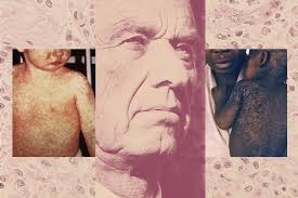 The CDC buried a measles forecast that stressed the need for vaccinations •  Louisiana Illuminator