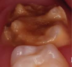 Bon secours mary immaculate hospital is a medical facility located in newport news, va. Molar Incisor Hypomineralisation Mih An Overview British Dental Journal